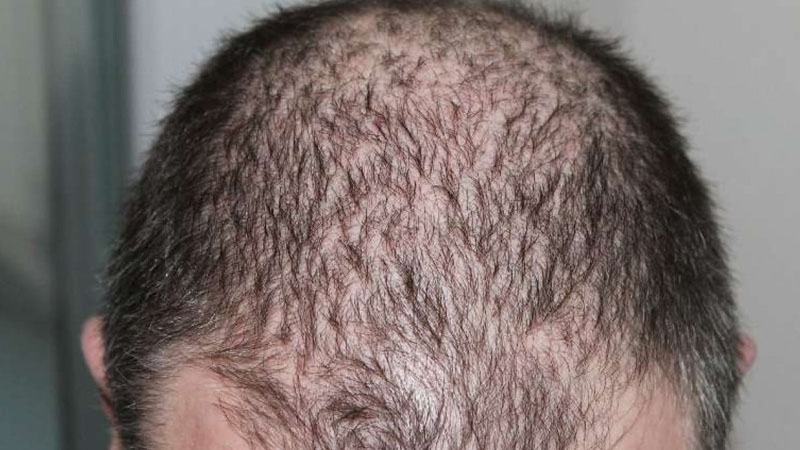 Mitos Soal Rambut Rontok: Fakta atau Sekadar Anggapan? – PAFI Kab. Kubu Raya